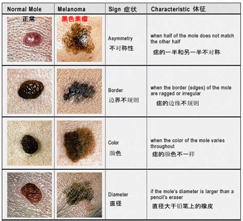 胸部長黑痣|胸部突然長痣是癌症的症狀